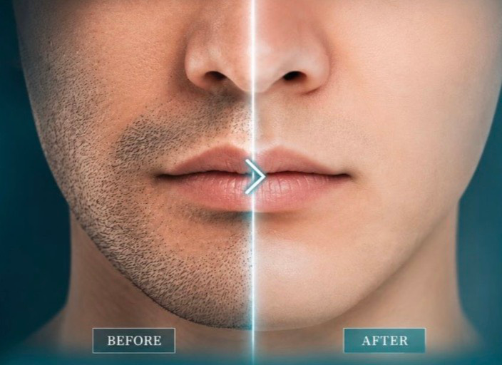 ヒゲ脱毛 BEFORE / AFTER